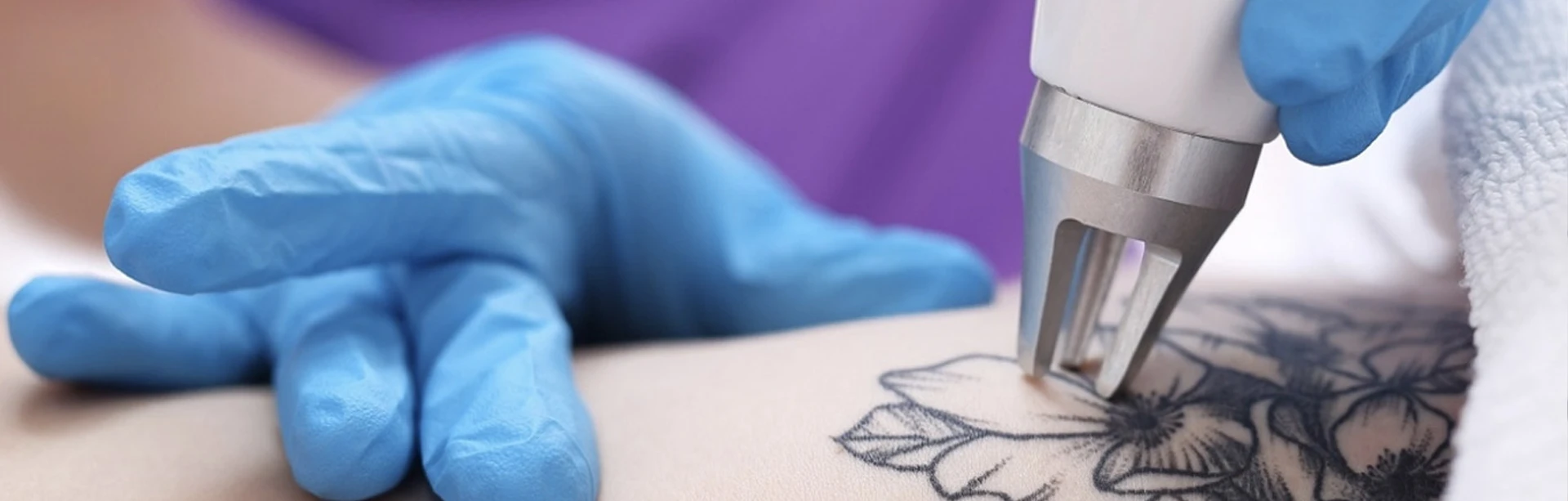 How Does Laser Tattoo Removal Work | RenewMD