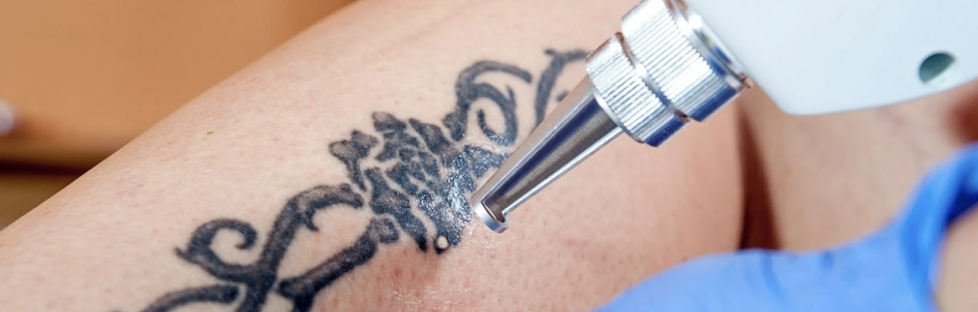 Does Tattoo Removal Hurt? We Answer Your Questions | RenewMD