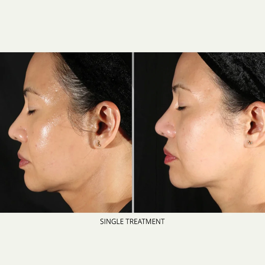 XERF | RenewMD Wellness & Aesthetics