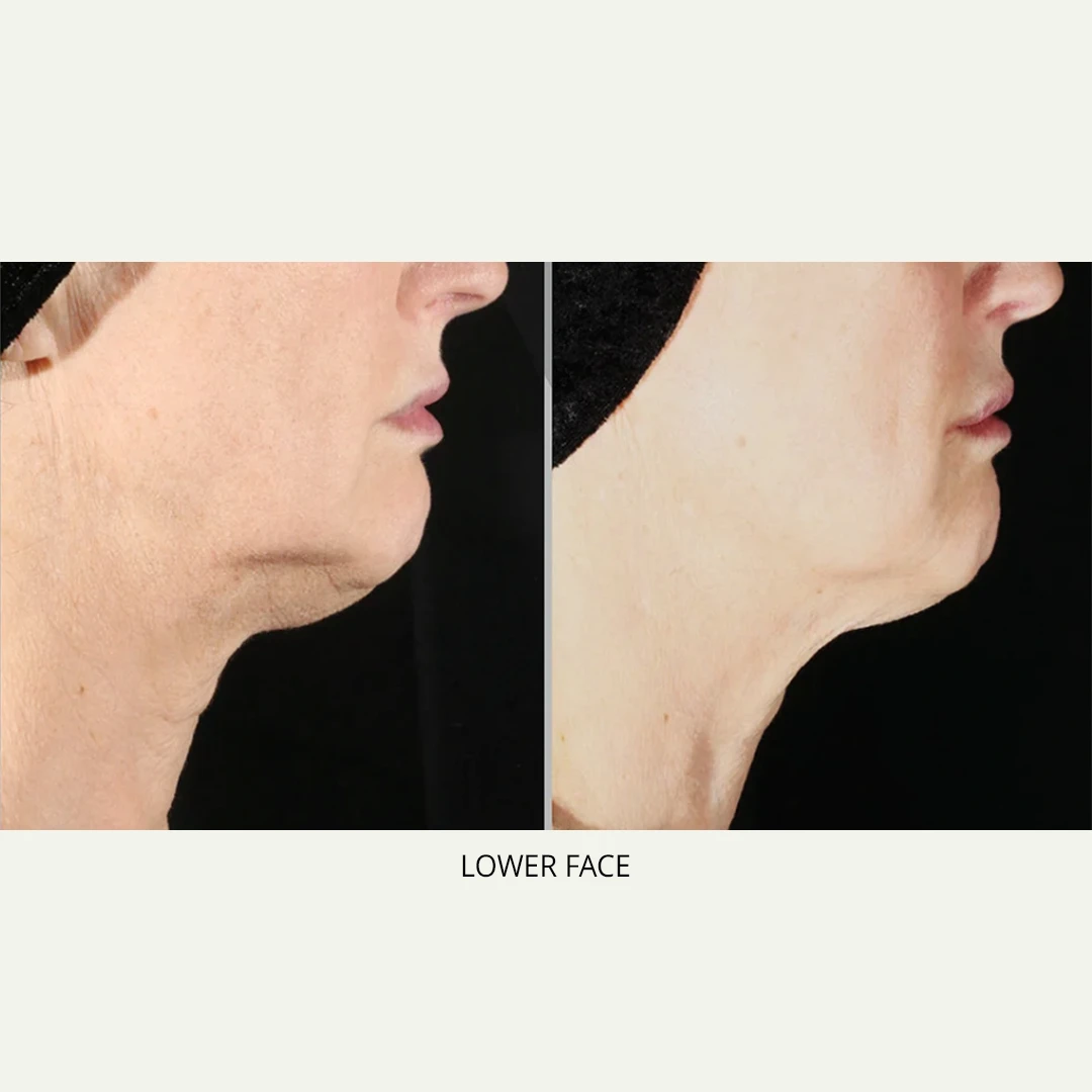 XERF | RenewMD Wellness & Aesthetics