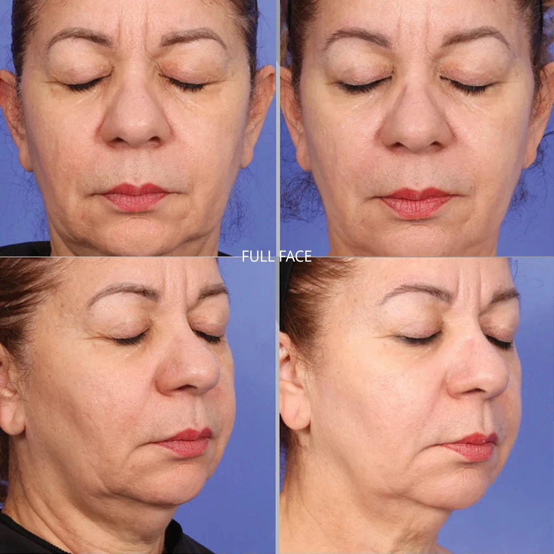 XERF | RenewMD Wellness & Aesthetics