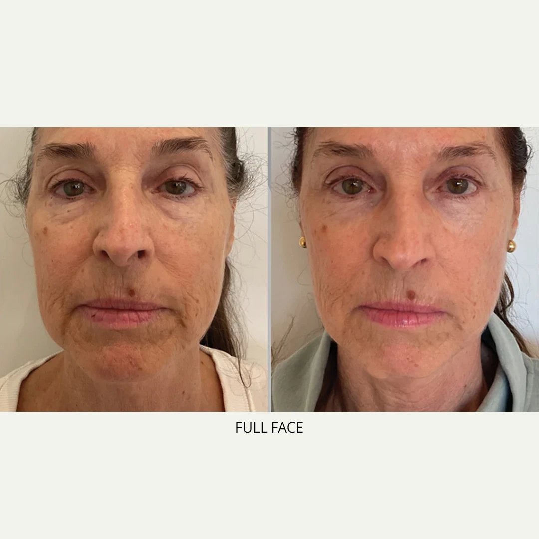 XERF | RenewMD Wellness & Aesthetics