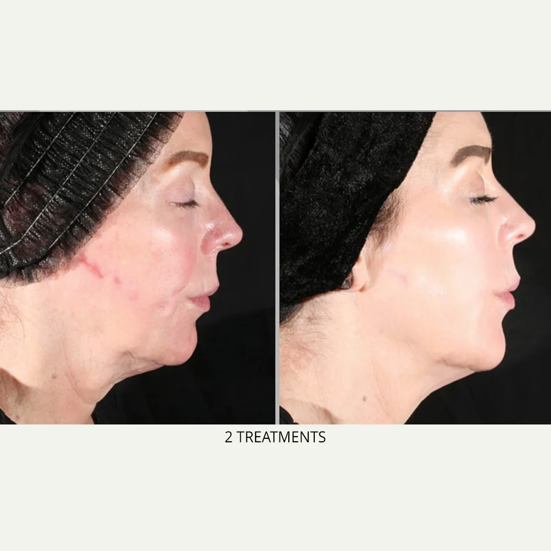 XERF | RenewMD Wellness & Aesthetics