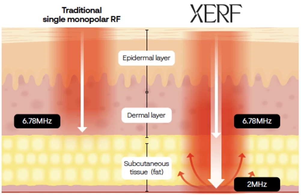 XERV vs. Thermage & Ultherapy | RenewMD Wellness XERV vs. Thermage & Ultherapy | RenewMD Wellness