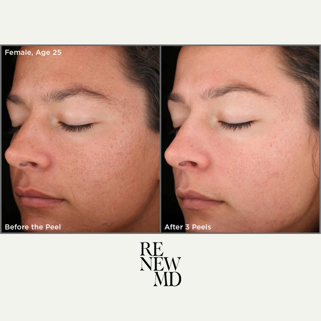 Medical-Grade Chemical Peels | Before/After | RenewMD
