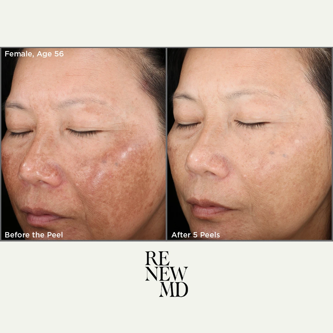 Medical-Grade Chemical Peels | Before/After | RenewMD
