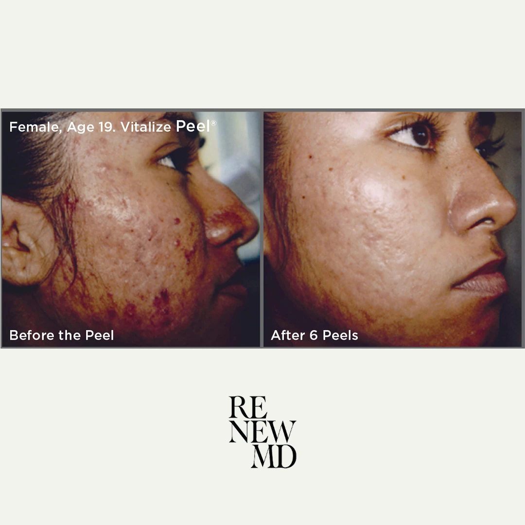 Medical-Grade Chemical Peels | Before/After | RenewMD