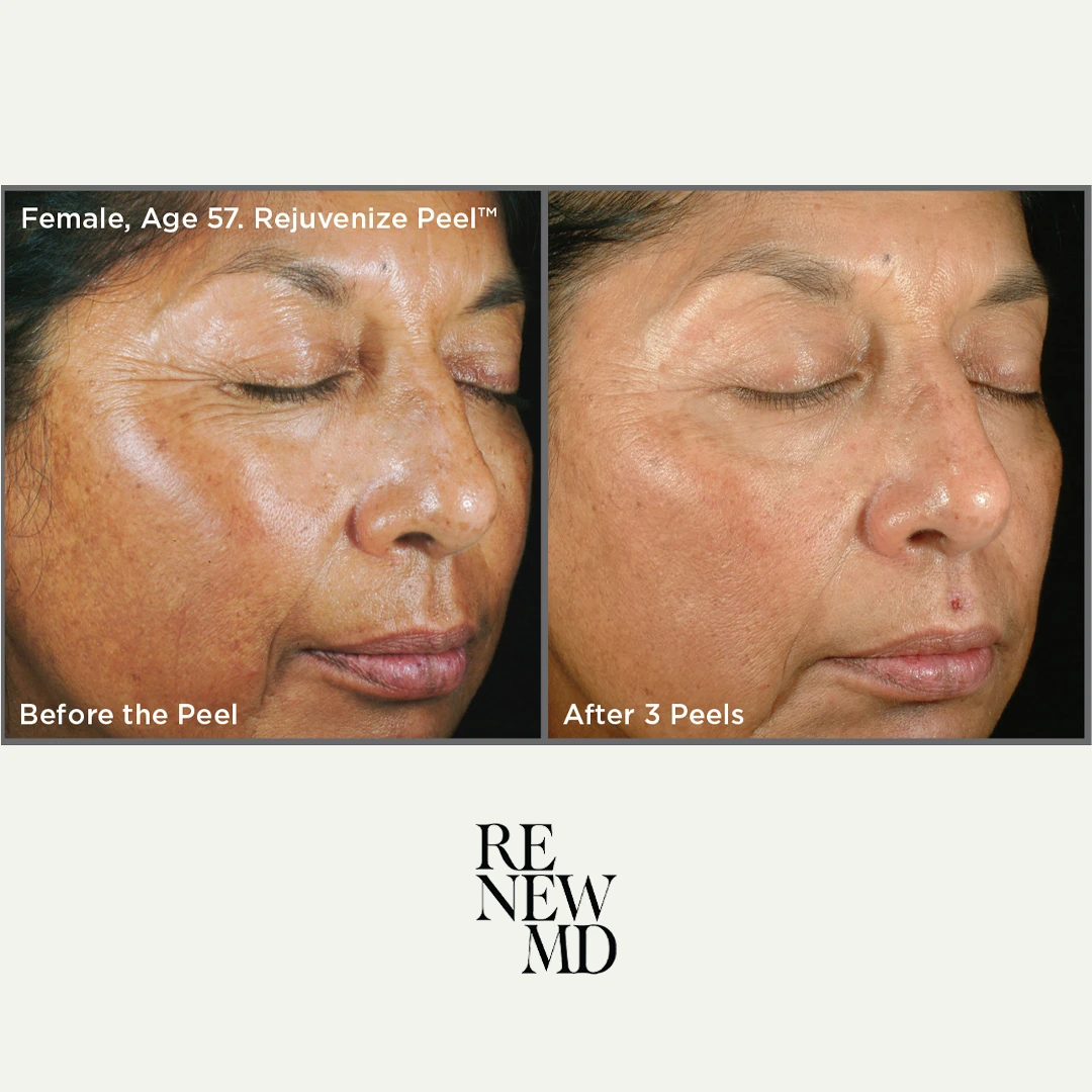 Medical-Grade Chemical Peels | Before/After | RenewMD
