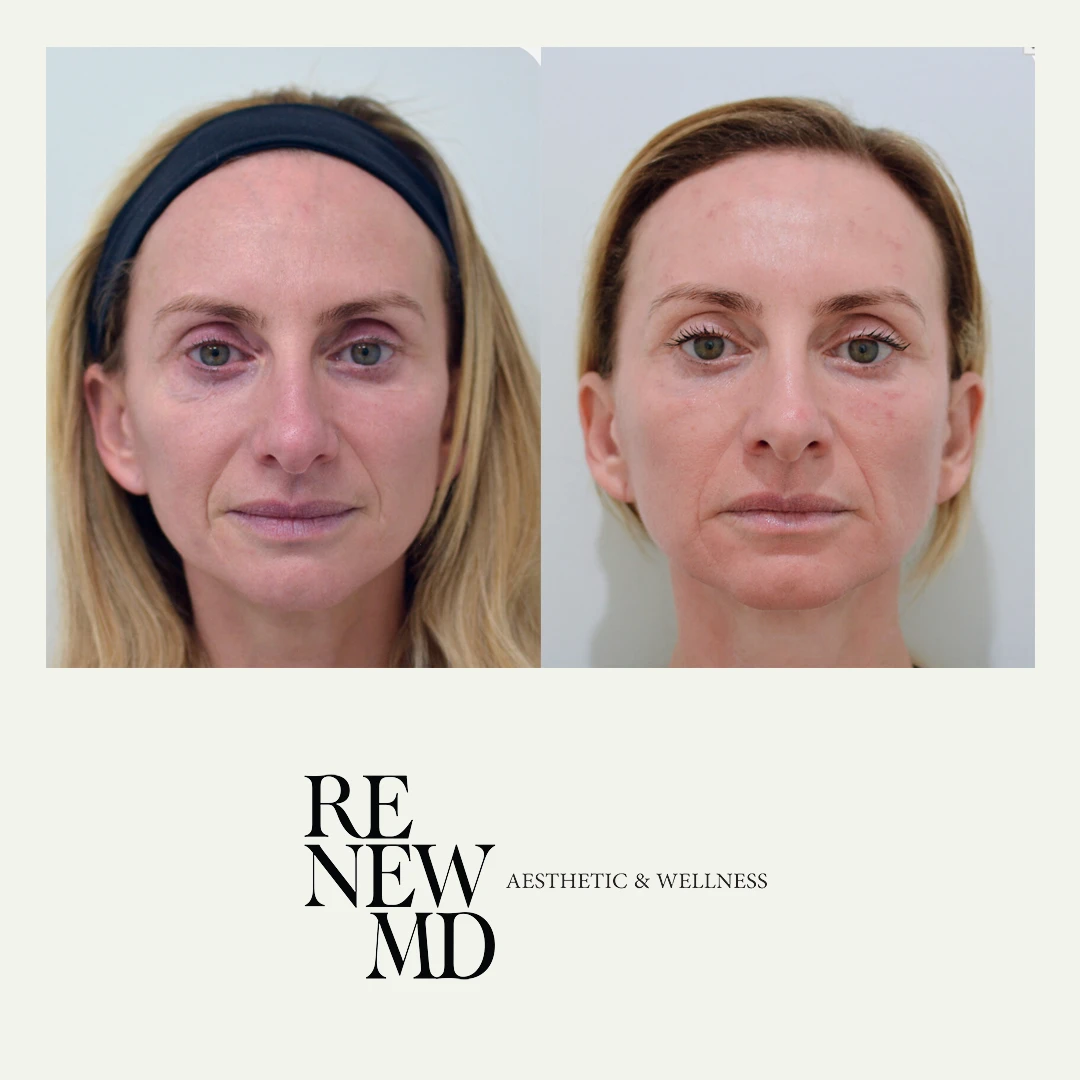 Ariessence PDGF | Before & After | RenewMD Wellness
