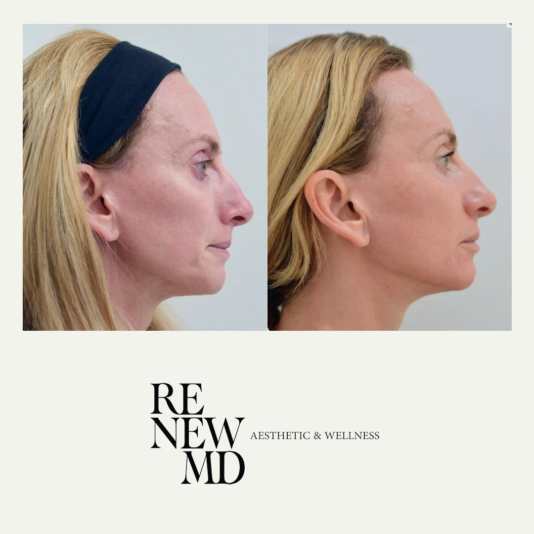 Ariessence PDGF | Before & After | RenewMD Wellness