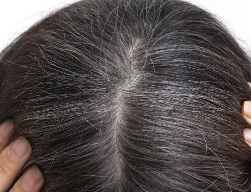 Does Menopause Cause Hair Loss? Signs, Statistics, Causes & Treatments (2026 Guide)