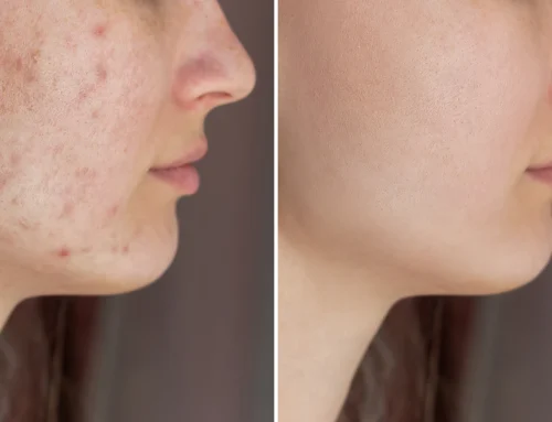 Subcision for Acne Scars (2026 Guide): How It Works, When to Use It & Combination Treatment Strategies
