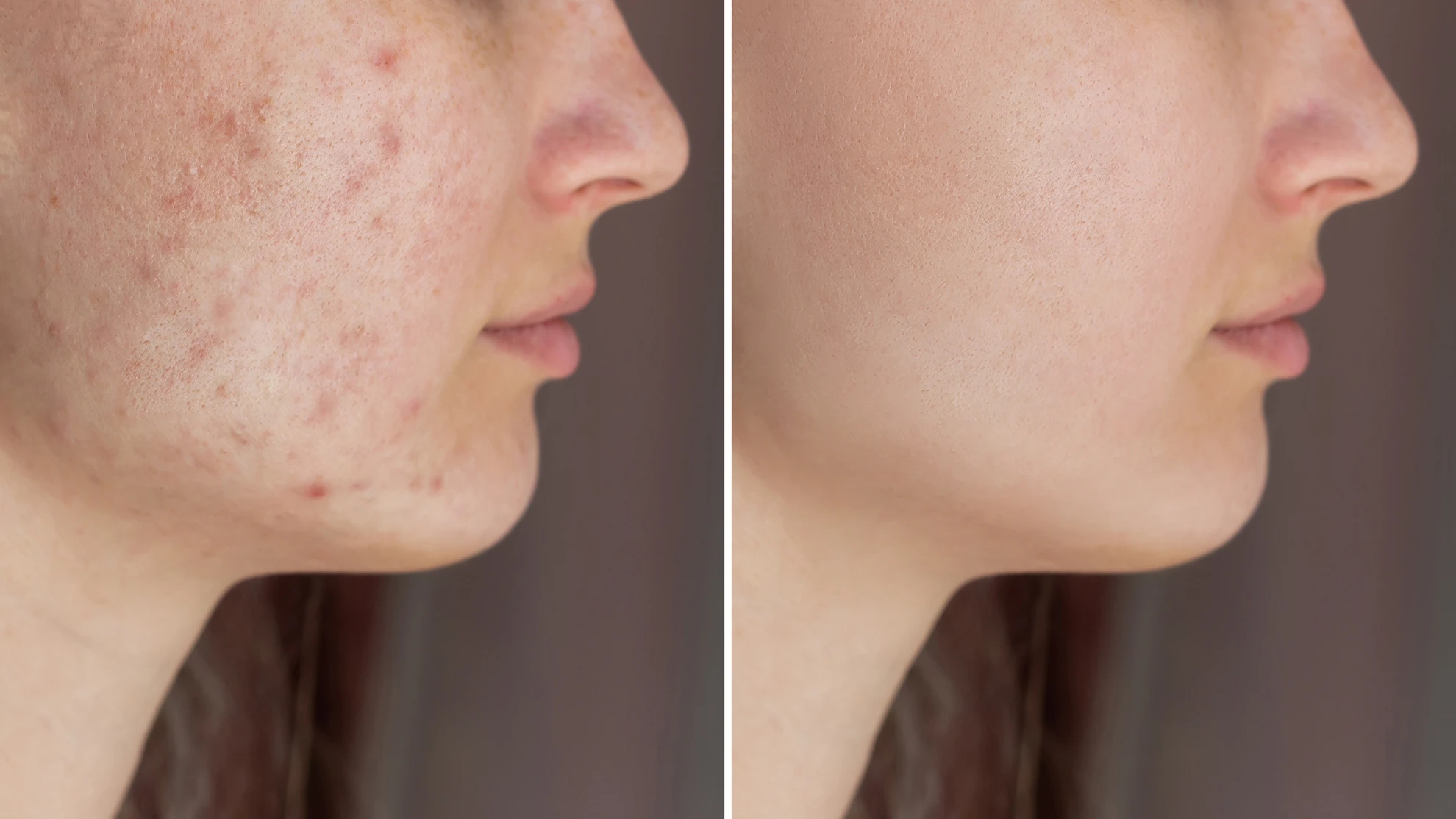 Subcision for Acne Scars (2026 Guide): How It Works, When to Use It & Combination Treatment Strategies