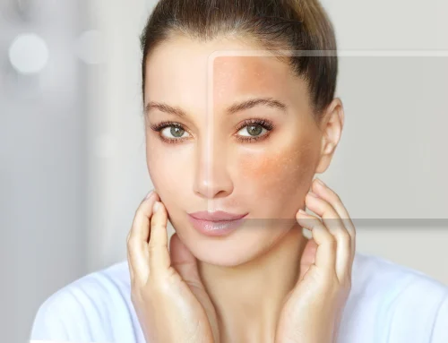 Breakthroughs in Melasma Treatment: How PicoSure Laser Pigment-Seeking Technologies and Combination Treatments Are Changing Melasma and Hyperpigmentation Treatment