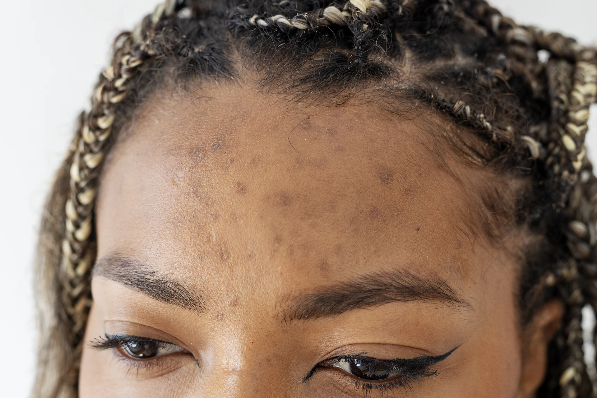 Breakthroughs in Melasma Treatment: How PicoSure Laser Pigment-Seeking Technologies and Combination Treatments Are Changing Melasma and Hyperpigmentation Treatment