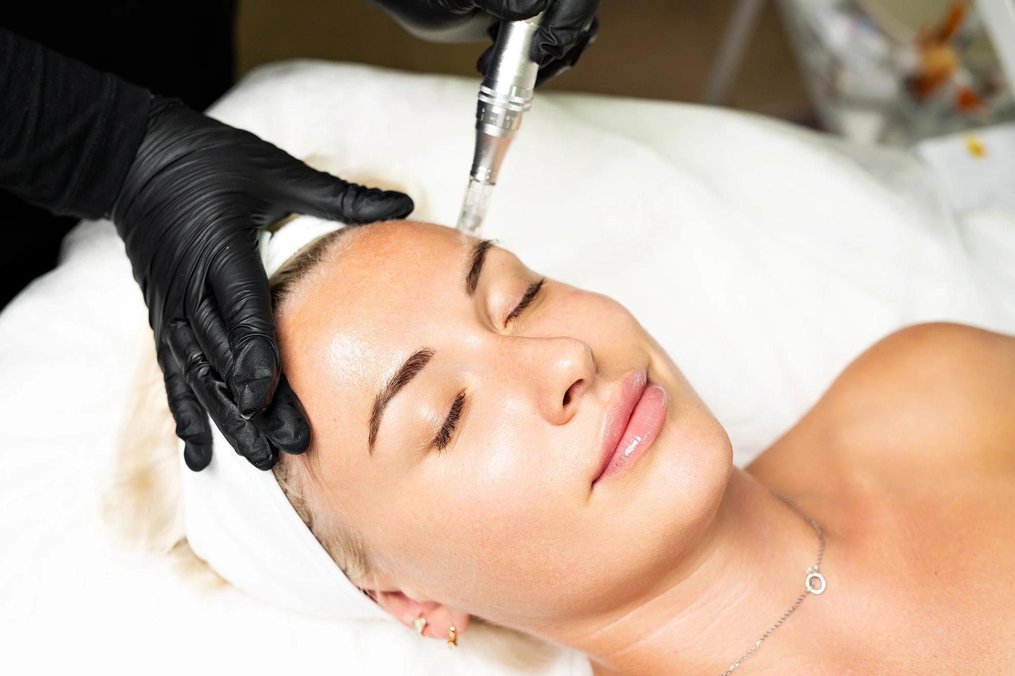 Microneedling with Exosomes (2026): Advances in Regenerative Aesthetics. The Future of Skin Rejuvenation, Hair Restoration, and Longevity Medicine