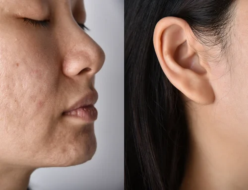 The New Acne Scar Treatments (2026): Regenerative Therapies, Laser Resurfacing & Combination Treatment Guide