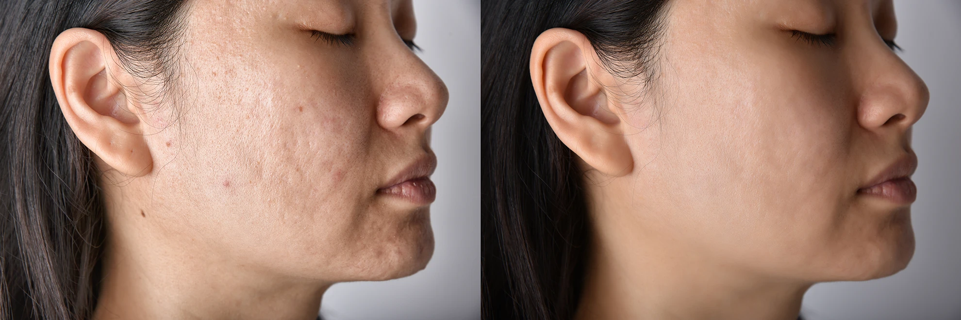 The New Acne Scar Treatments (2026): Regenerative Therapies, Laser Resurfacing & Combination Treatment Guide