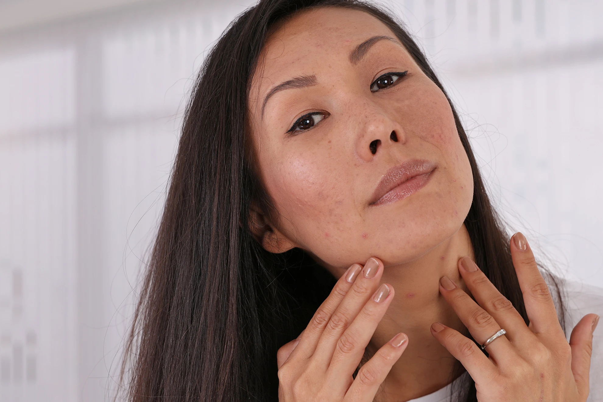 The New Acne Scar Treatments (2026): Regenerative Therapies, Laser Resurfacing & Combination Treatment Guide