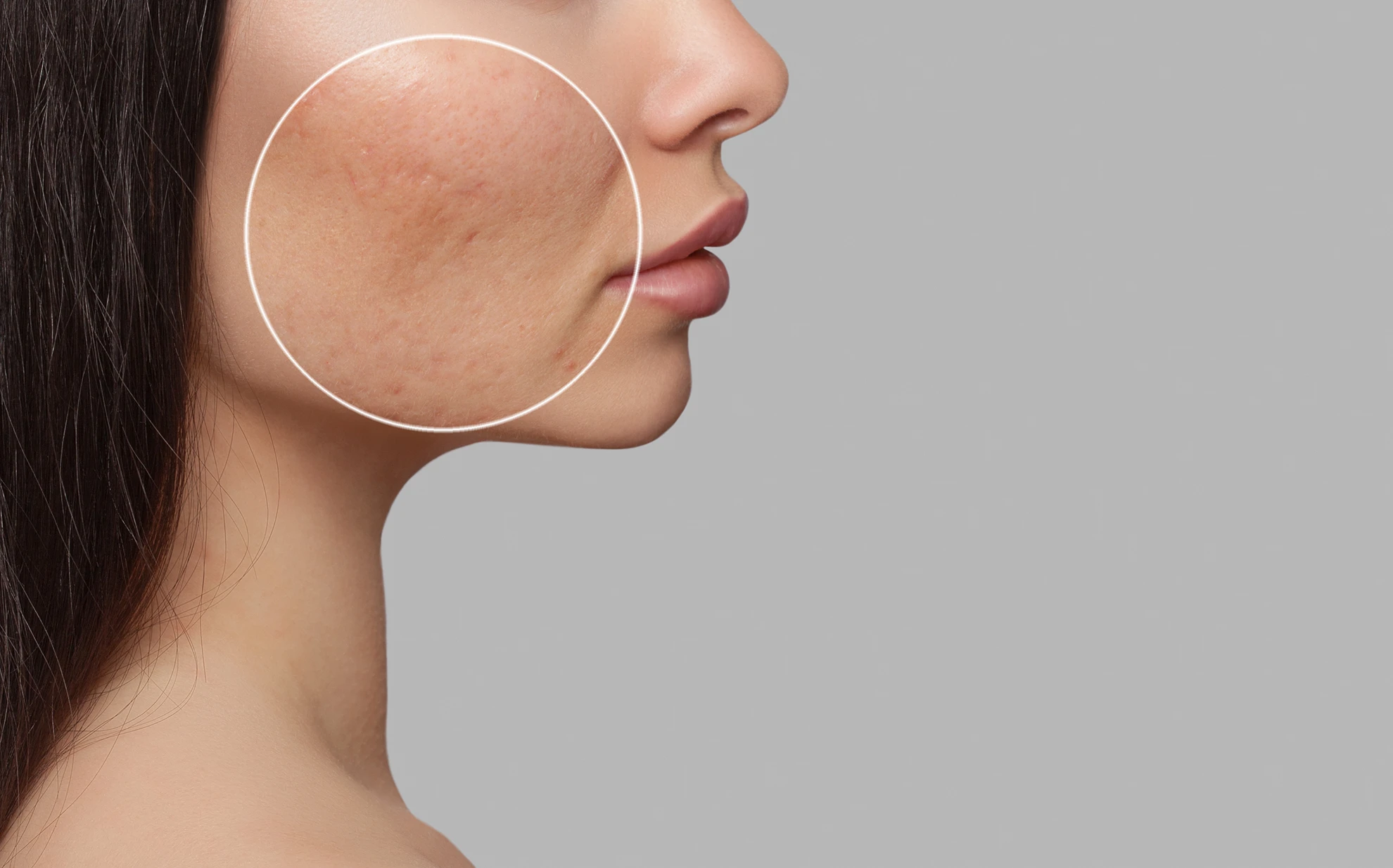 The New Acne Scar Treatments (2026): Regenerative Therapies, Laser Resurfacing & Combination Treatment Guide