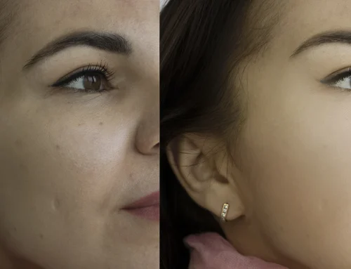 Can You Stop Acne Breakouts? (2026 Guide to Acne Prevention, Skin Health & Regenerative Treatments)