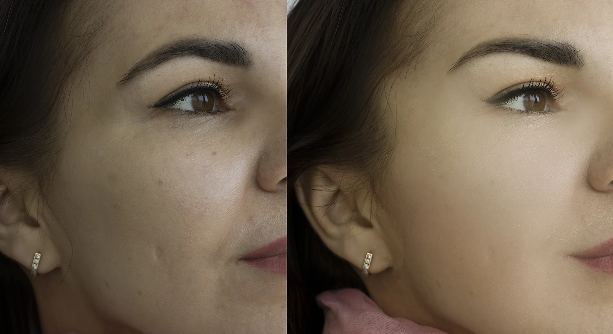Can You Stop Acne Breakouts? (2026 Guide to Acne Prevention, Skin Health & Regenerative Treatments)