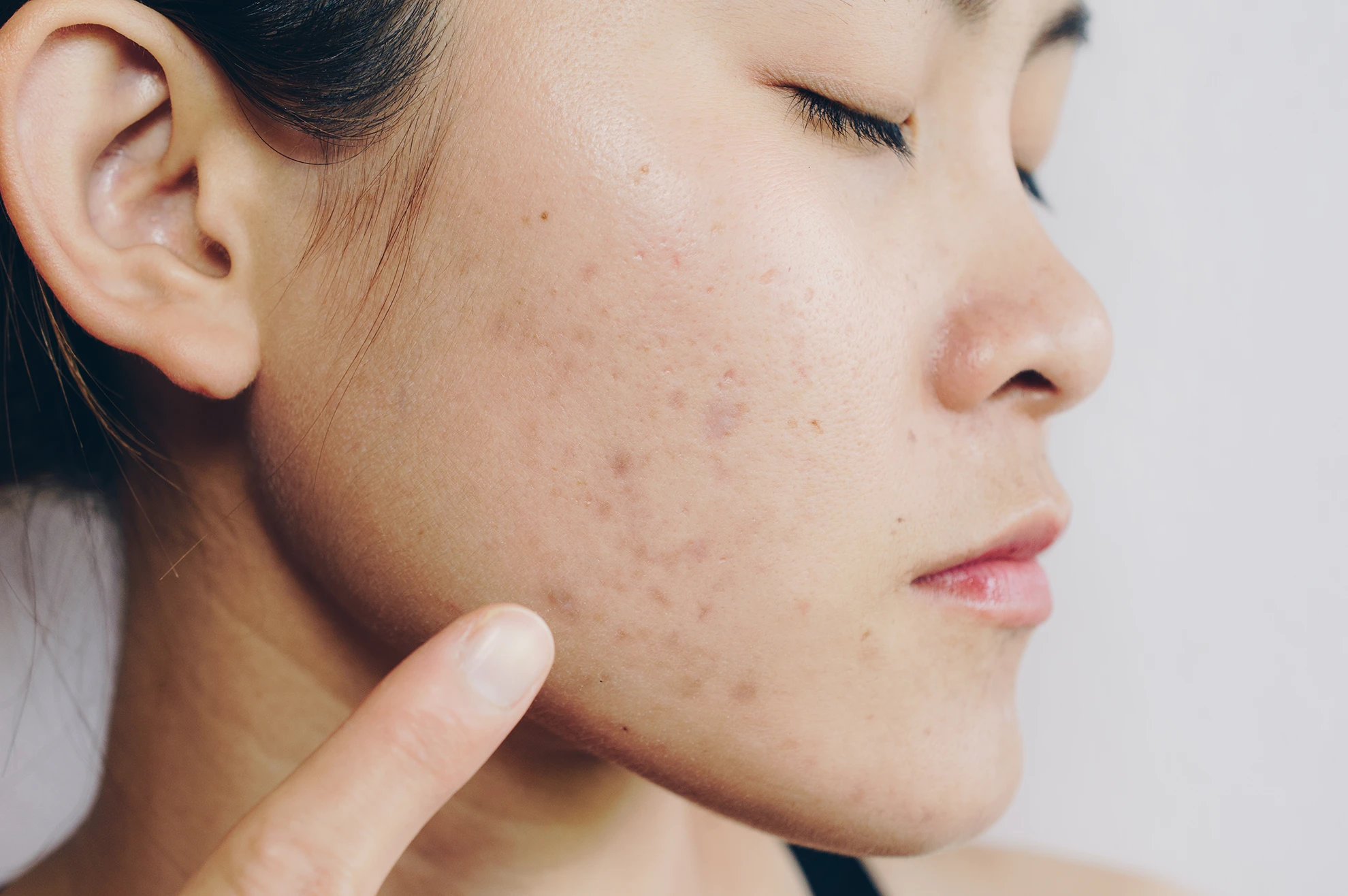 Can You Stop Acne Breakouts? (2026 Guide to Acne Prevention, Skin Health & Regenerative Treatments)