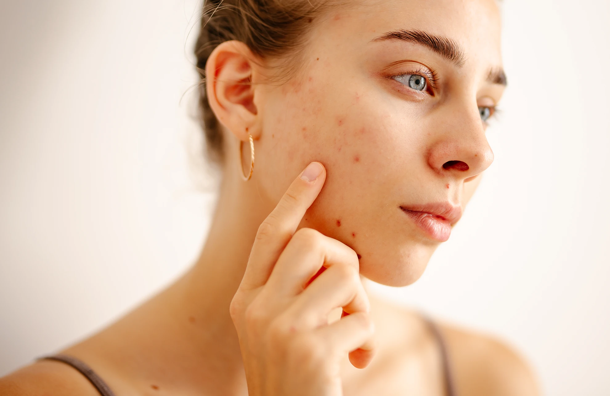 Can You Stop Acne Breakouts? (2026 Guide to Acne Prevention, Skin Health & Regenerative Treatments)