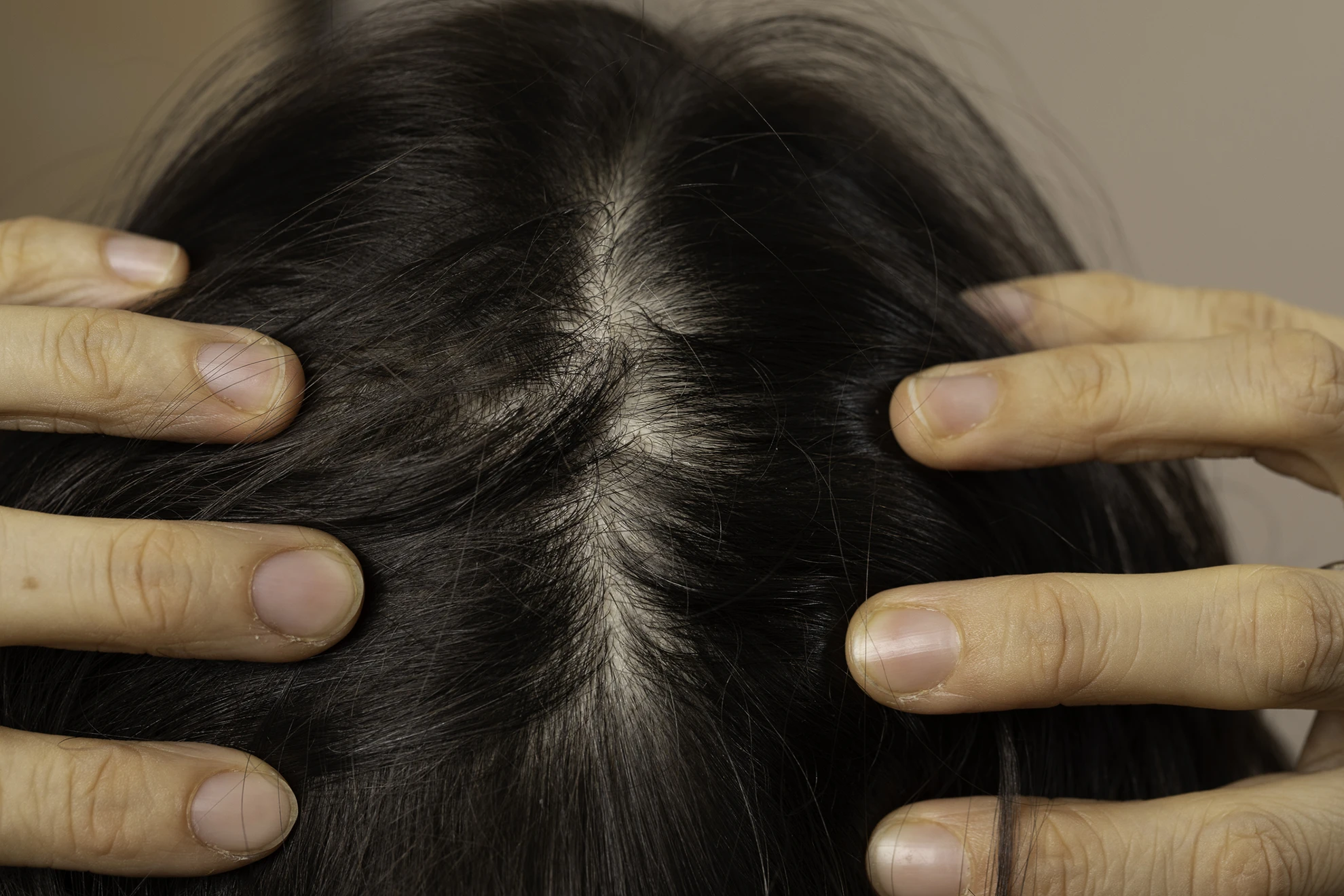 Is Stem Cell Therapy for Hair Loss Different for Men and Women? The New Science of Regenerative Hair Restoration