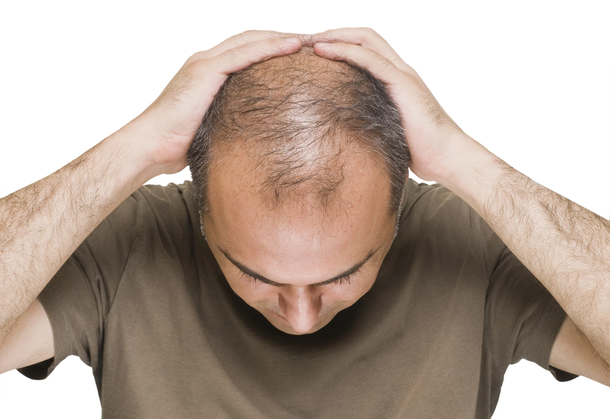 Is Stem Cell Therapy for Hair Loss Different for Men and Women? The New Science of Regenerative Hair Restoration
